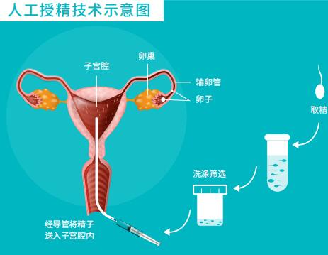 人工授精的過(guò)程與費(fèi)用