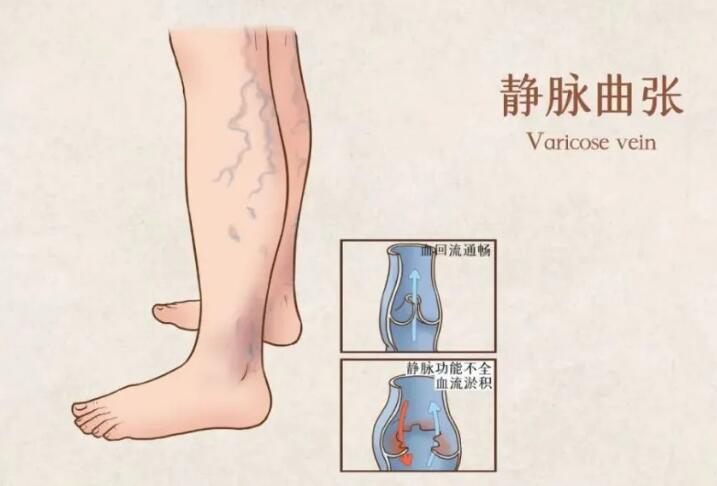 靜脈曲張困擾女性健康怎么辦   如何做好護(hù)理