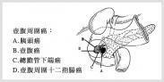 壺腹周圍癌