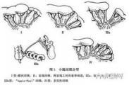 先天性結腸狹窄和閉鎖