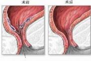 外傷性腹膜后出血或血腫